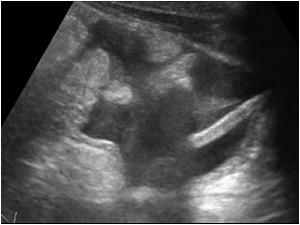 Longtudinal image of the lower abdomen showing some fluid / blood