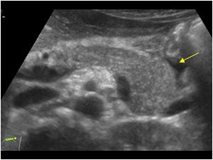 Transverse image of the spleen with some fluid around the tail