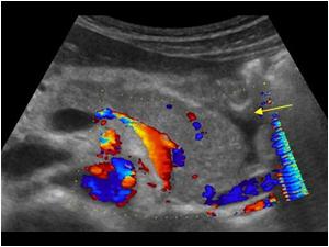 Transverse image of the pancreas. No flow in the fluid around the tail. Normal splenic vein
