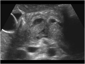 Transverse image of the pancreatic rupture