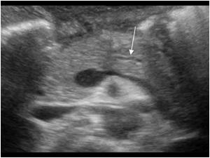 The pancreatic duct in the distal part of the pancreas can be followed to the sie of rhe rupture