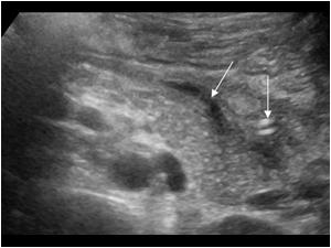 Pancreas after percutaneous drainage with a small effusion and the drain next to the pancreas tail