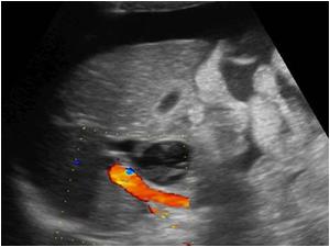 Normal flow in the portal vein, but no flow in the diatated common bile duct 