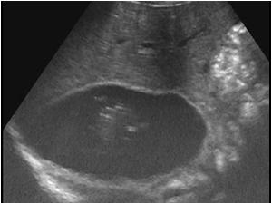 Large fluid filled structure in the right upper abdomen