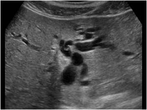 Transverse image of left liver lobe showing dilatated intrahepatic bile ducts.