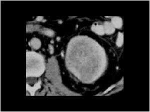 Renal cell carcinoma with calcifications