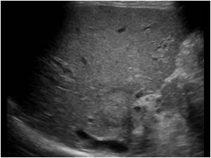 The intrahepatic bile ducts of the right liver lobe are not so dilatated