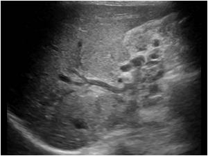 Image of the liver hilum showing the obstruction of the portal vein and collateral veins in the gallbladder region