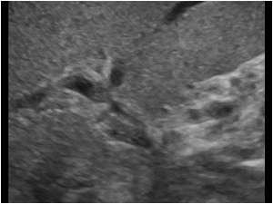 Detail image of the liver hilum showing tumor in the portal veins
