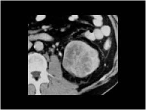 Renal cell carcinoma with calcifications