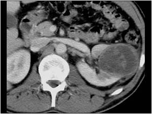 Renal cell carcinoma with cystic spaces