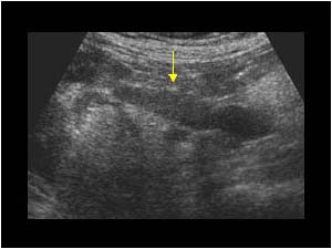 Thrombus in the right renal vein
