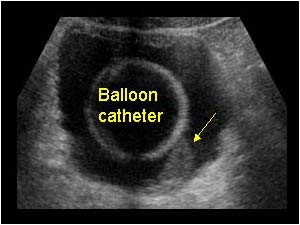 Expansion in the left ureter and bladder