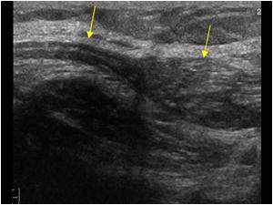 Longitudinal image of the peroneal nerve next to the fibular head. The proximal part of the nerve shows a normal fascicular pattern. The distal part is abnormal