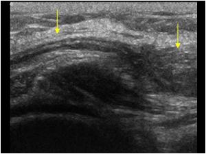 Another longitudinal image of the peroneal nerve with a normal proximal and abnormal distal part