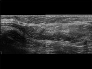 Another longitudinal image showing the relation of the lipomatous structure and the peroneal nerve