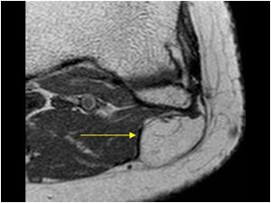 MRI image showing the lipoma