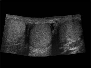 Transverse image showing 3 scrotal structures