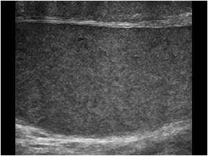 Longitudinal image of a normal left testis