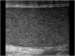 Longitudinal image of a normal right testis