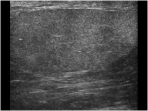 Longitudinal image of the structure next to the right testis