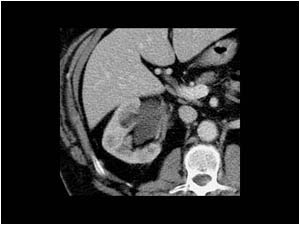 Renal cell tumor in the renal pelvis and ureter