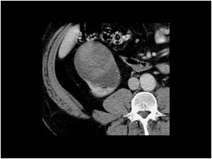 Renal cell tumor in the renal pelvis and ureter