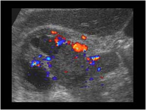 Tumor in the renal pelvis transverse