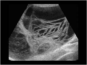 Septated cystic mass with solid structures