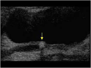 Distal ureter stone longitudinal