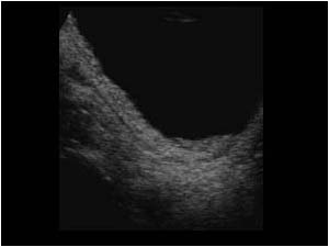 Hyperperistalsis in the distal ureter 1