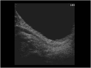 Hyperperistalsis in the distal ureter 3