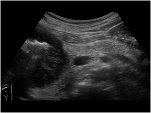 Transverse image of the upper abdomen shows a normal pancreas with a mass next to the pancreatic head