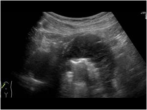 Longitudinal image of the upper abdomen. There is a semicircular mass with air and in close relation to the gallbladder