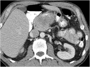 CT image of the mass in the upper abdomen