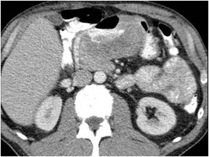 Ct image shows air in the tumor mass