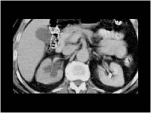 Dilatation of the right kidney