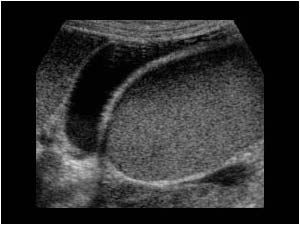 Dilatated renal pelvis impressing the gallbladder
