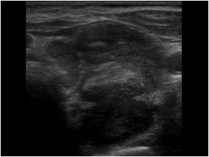 Transverse image of the left thyroid lobe with a large hypechoic mass