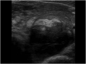 Another transverse image of an abnormal left thyroid lobe