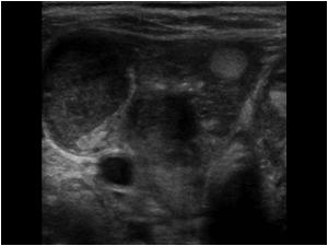Transvere image of the right thyroid lobe
