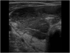 Another transverse image of the right thyroid lobe