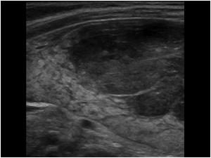 Longitudinal image of the right thyroid lobe.
Biopsy proved the thyroid masses to be a marginal zone lymphoma These extranodal cancers are also called mucosa-associated lymphatic tissue lymphomas lymphomas, or MALT lymphomas.