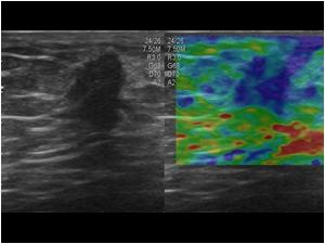 With elastography the mass is stiffer (dark blue) than the surrounding tissues