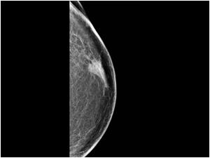 Cranio caudal view of the mass with mammography