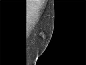 Medio latero oblique view of the mass with mammography