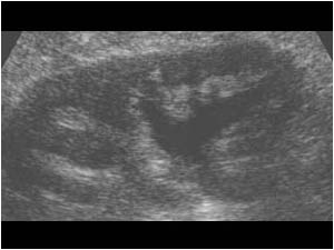 Obstruction in an incomplete duplex collecting system kidney longitudinal