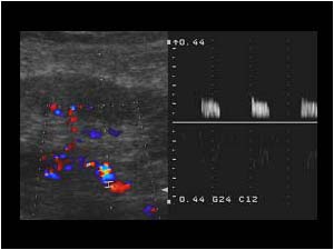 High resistance doppler signal in the renal artery