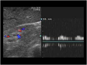 Right intrarenal doppler spectrum with dampened tardus/parvus waveform