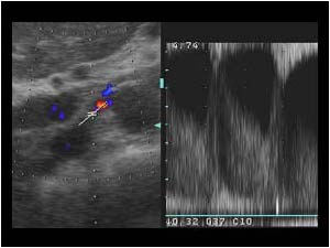 High systolic flow in the right renal artery stenosis